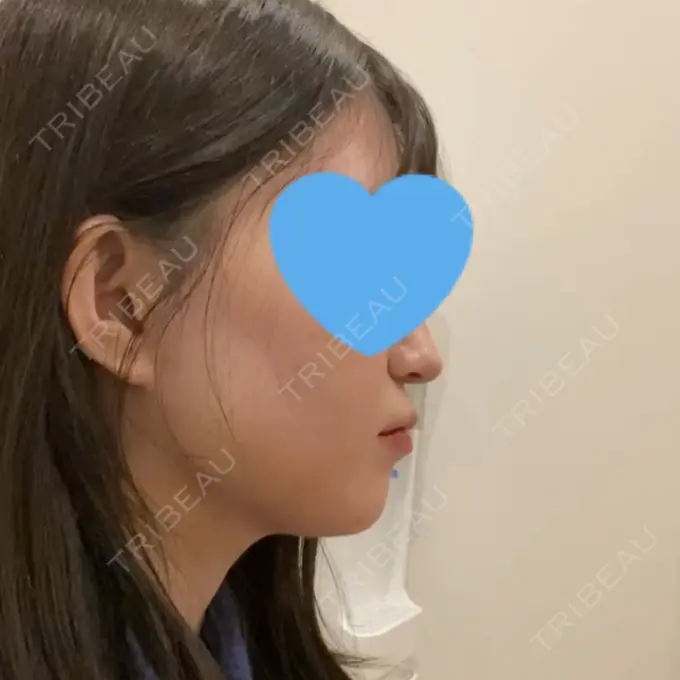 脂肪吸引（顔） / ボトックス（エラ・小顔） Otus Clinic 【オータスクリニック】 DAY 7 メイン用