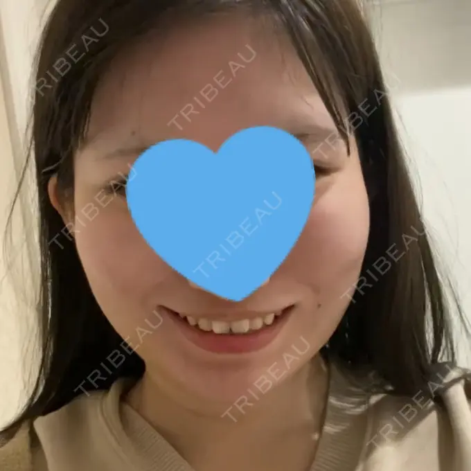 脂肪吸引（顔） / ボトックス（エラ・小顔） Otus Clinic 【オータスクリニック】 DAY 9 メイン用