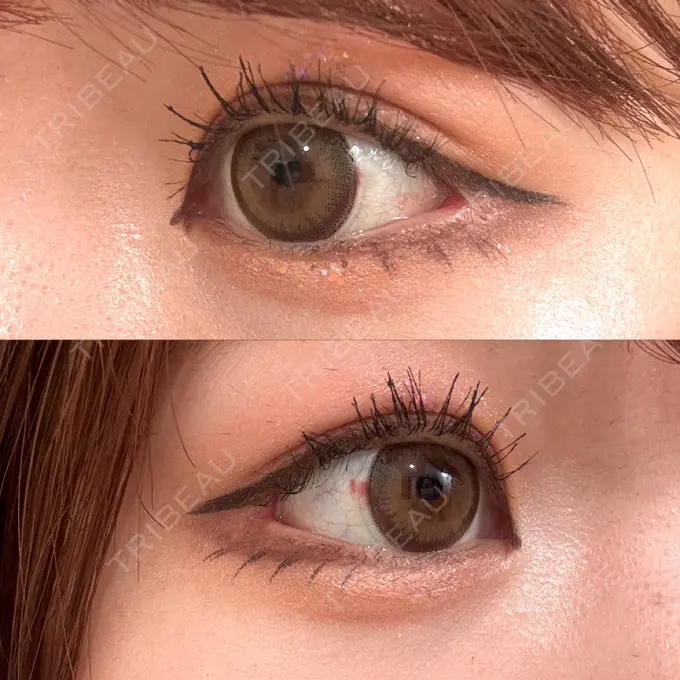 目尻切開 / 目尻靭帯移動 GLANZ CLINIC DAY 27 メイン用