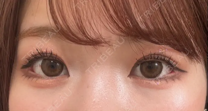 目尻切開 / 目尻靭帯移動 GLANZ CLINIC DAY 27 メイン用