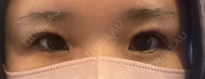 二重埋没 / 自然癒着法 CLINIC W DAY 0 メイン用