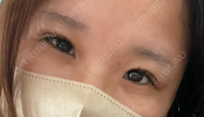 二重埋没 / 自然癒着法 CLINIC W DAY 1 メイン用