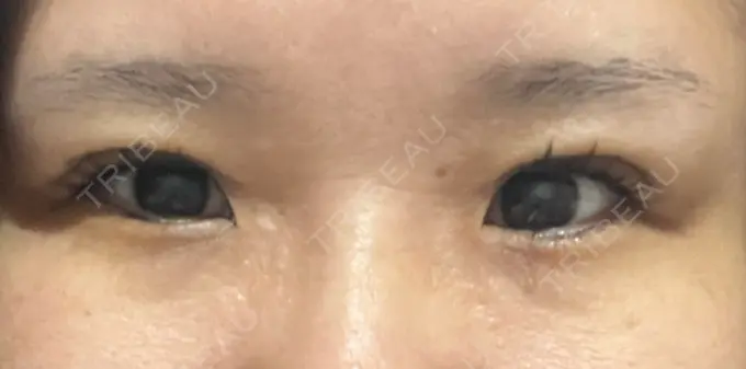 二重埋没 / 自然癒着法 CLINIC W DAY 2 メイン用