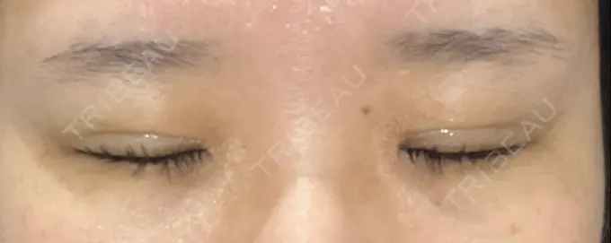 二重埋没 / 自然癒着法 CLINIC W DAY 2 メイン用