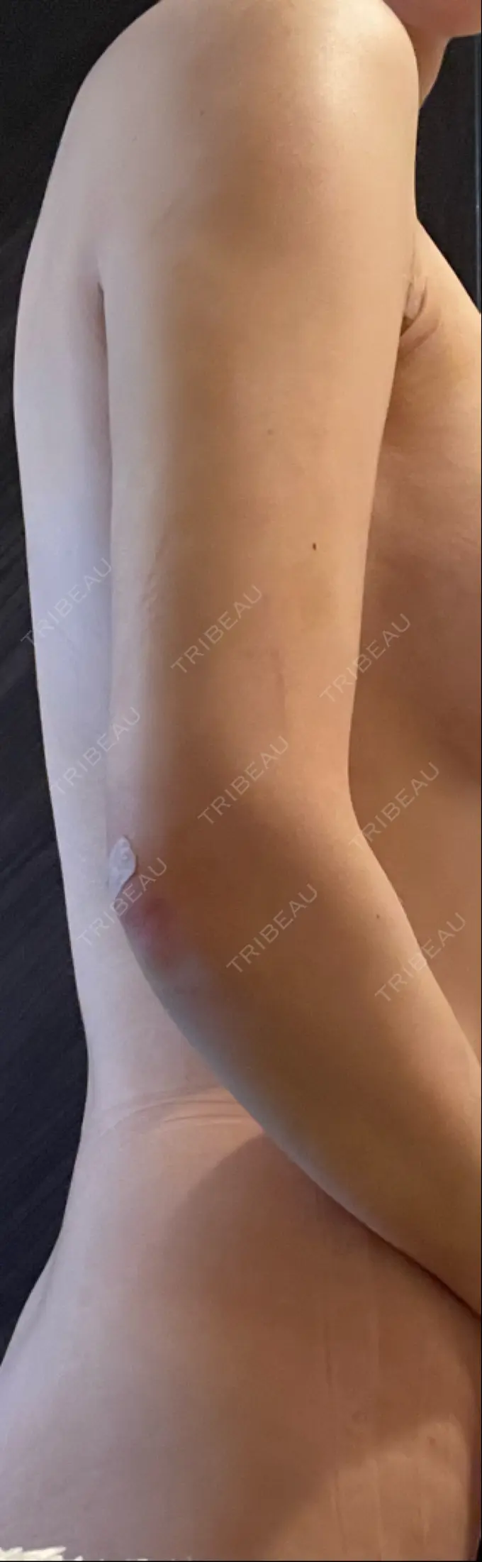 インディバ（肩） / インディバ（二の腕） WOM SALON【術後ケア取扱いサロン】 AFTER メイン用