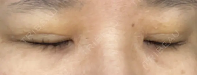 二重埋没 / 自然癒着法 CLINIC W AFTER メイン用