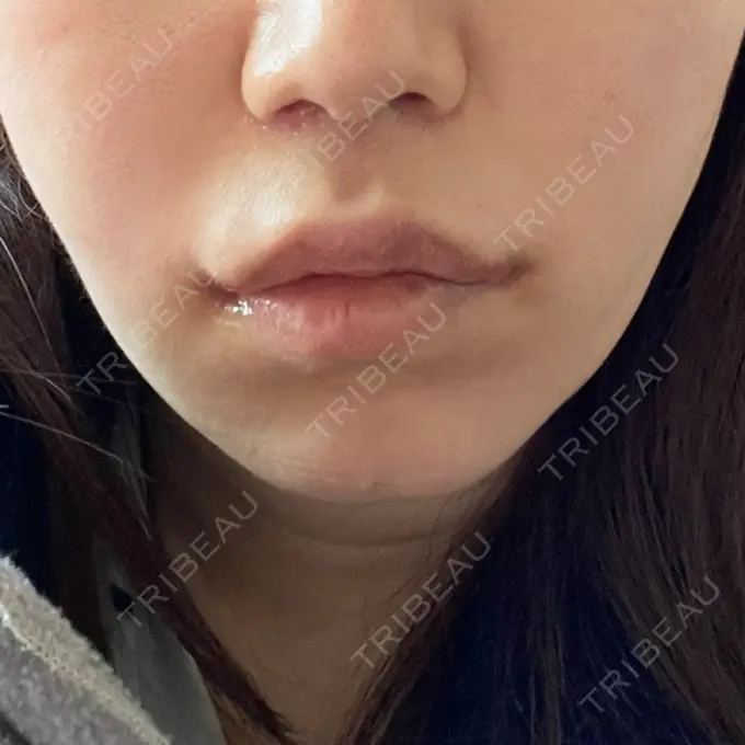 小鼻縮小（切開） / 糸リフト / 人中短縮 / 鼻翼挙上 / 口角挙上 / メーラーファット除去 / ボトックス（口角） Otus Clinic 【オータスクリニック】 DAY 16 メイン用