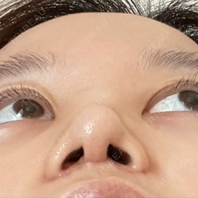 小鼻縮小（切開） / 糸リフト / 人中短縮 / 鼻翼挙上 / 口角挙上 / メーラーファット除去 / ボトックス（口角） Otus Clinic 【オータスクリニック】 DAY 16 メイン用