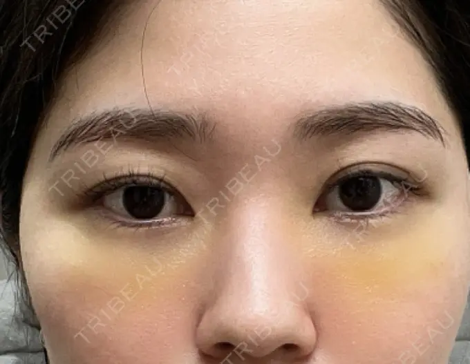 クマ治療 / 脂肪注入（目の下） 吉井クリニック DAY 7 メイン用