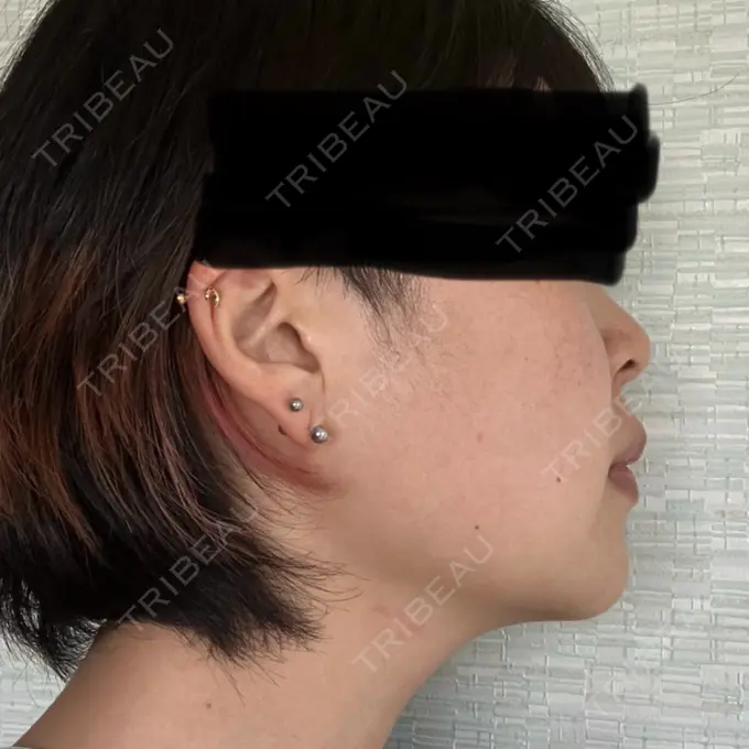 ハイフ（顔） TCB東京中央美容外科 京都四条院 AFTER メイン用