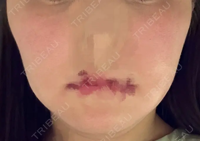 脂肪溶解注射（顔） 吉祥寺アイビークリニック DAY 0 メイン用