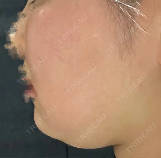 脂肪溶解注射（顔） 吉祥寺アイビークリニック DAY 0 メイン用