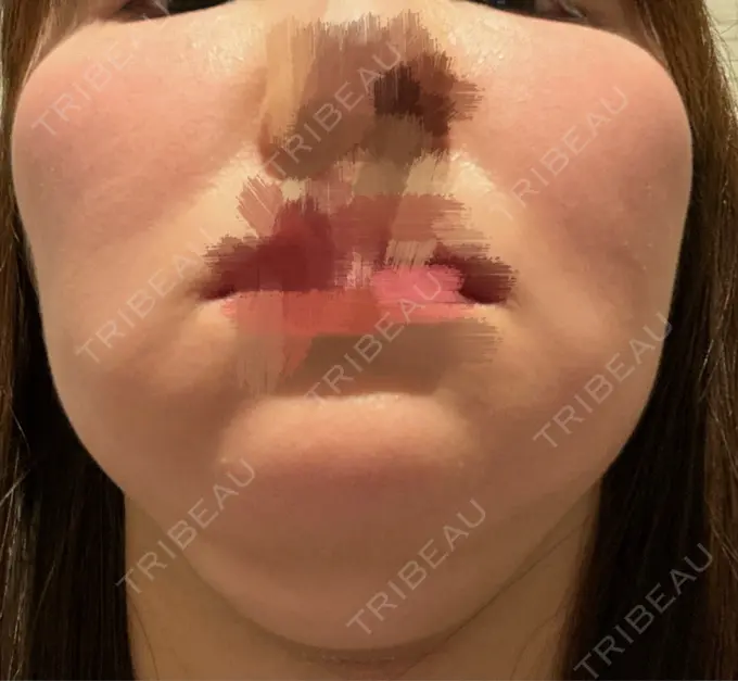 脂肪溶解注射（顔） 吉祥寺アイビークリニック DAY 0 メイン用