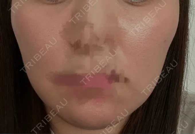 脂肪溶解注射（顔） 吉祥寺アイビークリニック DAY 1 メイン用