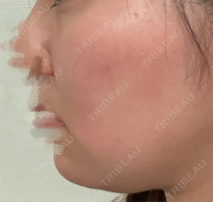 脂肪溶解注射（顔） 吉祥寺アイビークリニック DAY 1 メイン用