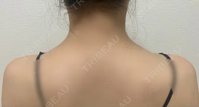 ボトックス（肩） / ボトックス（眉間） / ボトックス（額） ルラ美容クリニック 大阪本院 AFTER メイン用