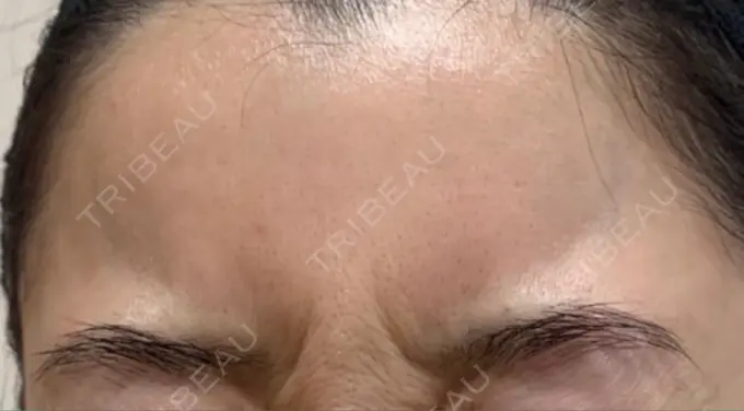 ボトックス（肩） / ボトックス（眉間） / ボトックス（額） ルラ美容クリニック 大阪本院 DAY 20 メイン用