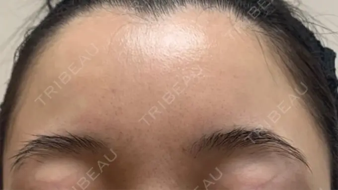 ボトックス（肩） / ボトックス（眉間） / ボトックス（額） ルラ美容クリニック 大阪本院 DAY 20 メイン用