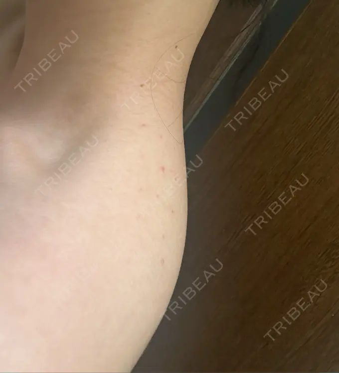 ボトックス（肩） 共立美容外科 名古屋院 DAY 0 メイン用