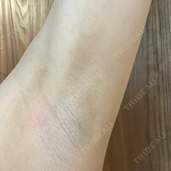 医療脱毛（ワキ） 湘南美容クリニック 秋葉原院 DAY 3 メイン用