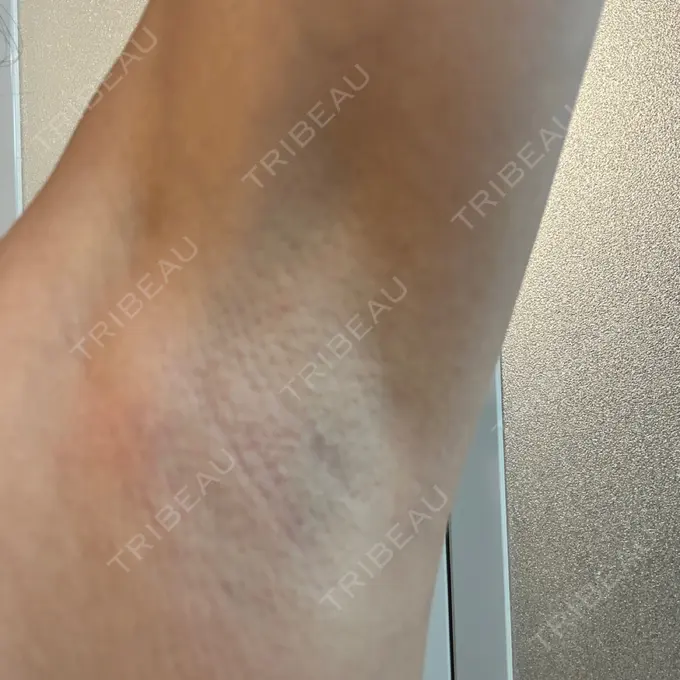 医療脱毛（ワキ） 湘南美容クリニック 秋葉原院 DAY 4 メイン用