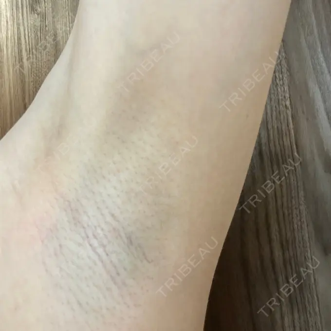 医療脱毛（ワキ） 湘南美容クリニック 秋葉原院 DAY 5 メイン用