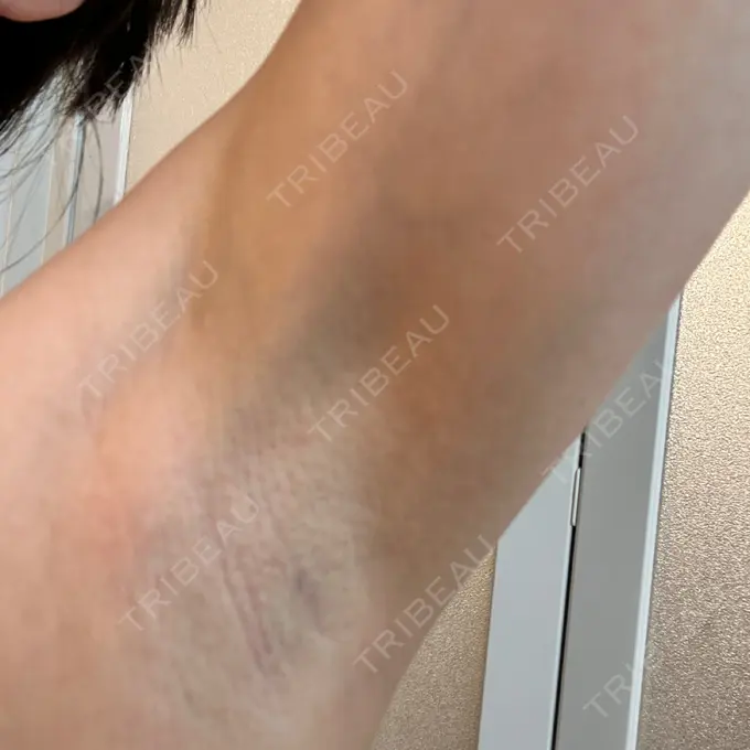 医療脱毛（ワキ） 湘南美容クリニック 秋葉原院 DAY 6 メイン用