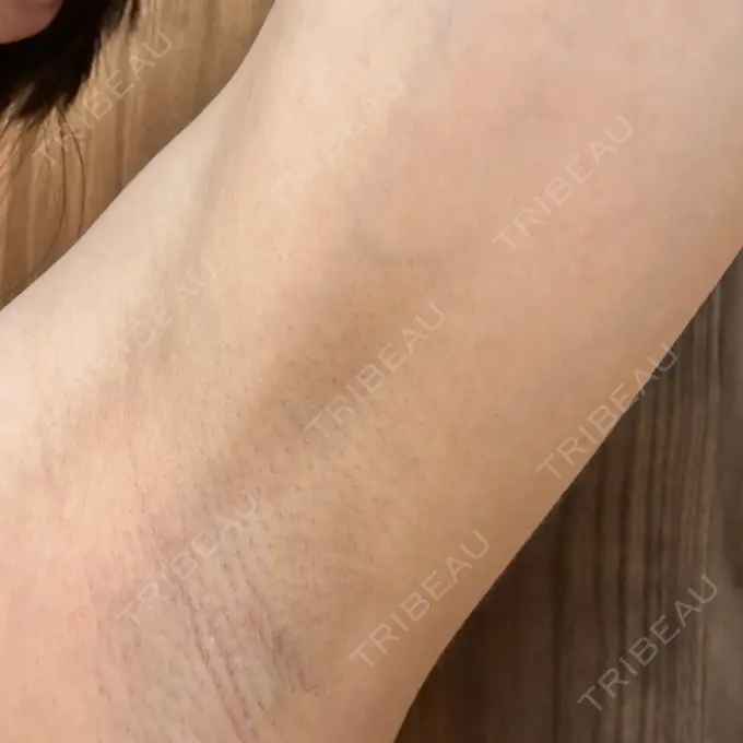 医療脱毛（ワキ） 湘南美容クリニック 秋葉原院 DAY 7 メイン用