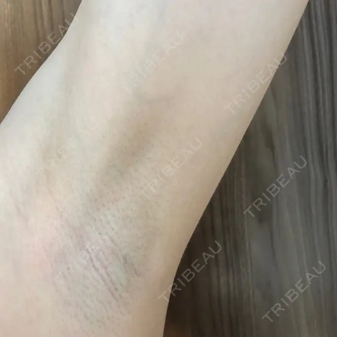 医療脱毛（ワキ） 湘南美容クリニック 秋葉原院 DAY 9 メイン用