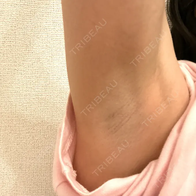 医療脱毛（ワキ） 湘南美容クリニック 秋葉原院 AFTER メイン用