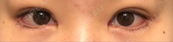 目頭切開 / クマ治療 / 目尻切開 / タレ目形成・グラマラスライン（切開） / 目尻靭帯移動 エターナル美容クリニック DAY 60 メイン用