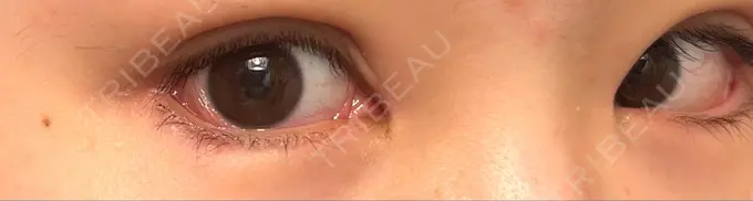 目頭切開 / クマ治療 / 目尻切開 / タレ目形成・グラマラスライン（切開） / 目尻靭帯移動 エターナル美容クリニック DAY 60 メイン用