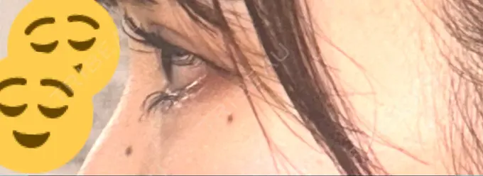 目頭切開 / クマ治療 / 目尻切開 / タレ目形成・グラマラスライン（切開） / 目尻靭帯移動 エターナル美容クリニック DAY 60 メイン用