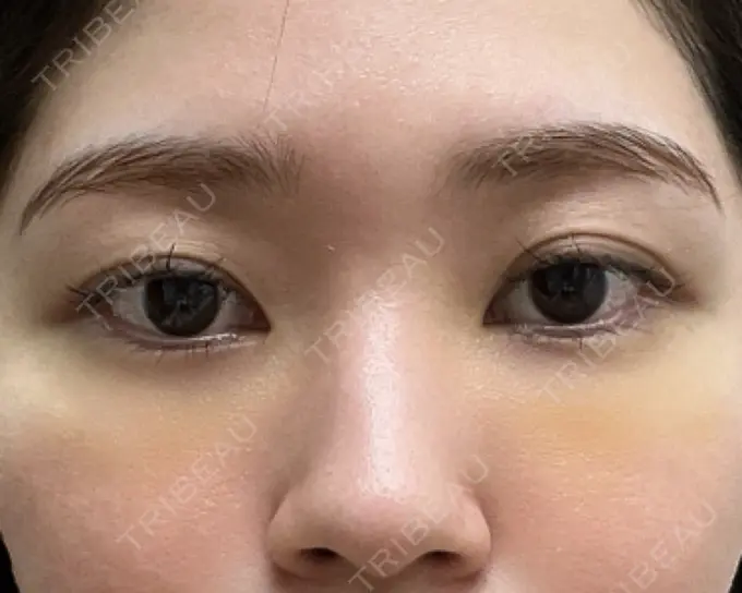 クマ治療 / 脂肪注入（目の下） 吉井クリニック DAY 8 メイン用