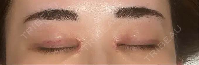 アートメイク（眉） にしまき美容スキンクリニック DAY 0 メイン用