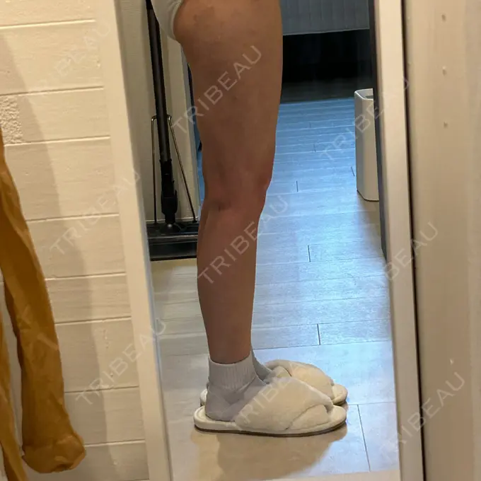 脂肪吸引（脚） / 脂肪吸引（お尻） Mods Clinic（モッズクリニック） 名古屋院 DAY 35 メイン用