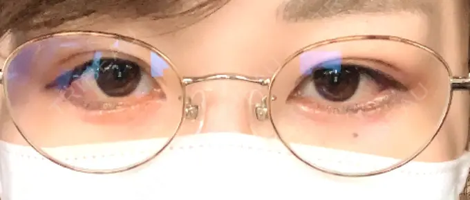 目尻切開 / タレ目形成・グラマラスライン（切開） / 目尻靭帯移動 エターナル美容クリニック DAY 18 メイン用