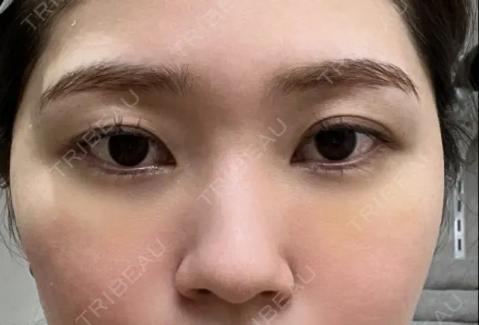 クマ治療 / 脂肪注入（目の下） 吉井クリニック DAY 8 メイン用