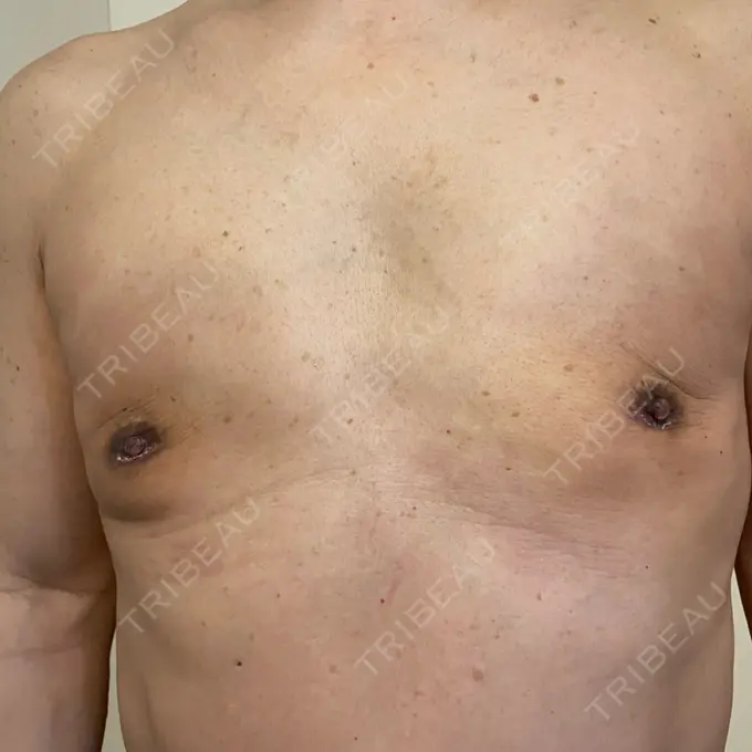 胸修正 / その他（胸） Mods Clinic（モッズクリニック） 大阪院 DAY 25 メイン用