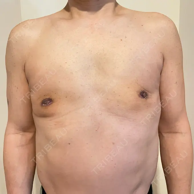 胸修正 / その他（胸） Mods Clinic（モッズクリニック） 大阪院 DAY 25 メイン用