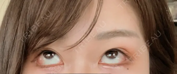 目尻切開 / タレ目形成・グラマラスライン（切開） / 目尻靭帯移動 エターナル美容クリニック DAY 19 メイン用