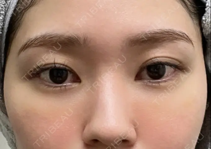 クマ治療 / 脂肪注入（目の下） 吉井クリニック DAY 9 メイン用