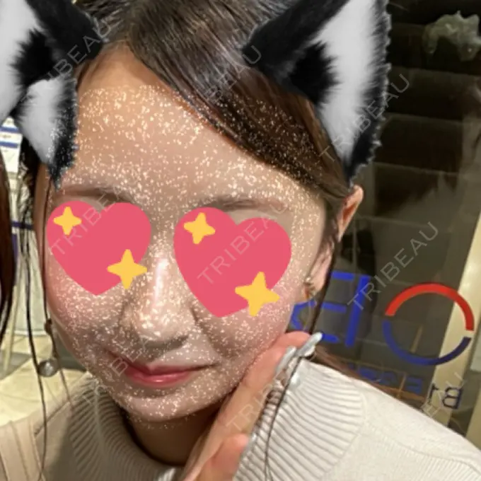 糸リフト / バッカルファット除去 / 脂肪吸引（顔） RIVER CLINIC（リバークリニック） AFTER メイン用