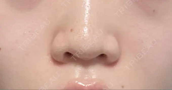 ヒアルロン酸注入（涙袋） / ボトックス（眉間） / ボトックス（ガミースマイル） / ヒアルロン酸注入（鼻翼基部） フィラークリニック 渋谷院 DAY 1 メイン用