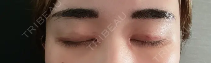 アートメイク（眉） にしまき美容スキンクリニック DAY 1 メイン用