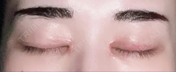 アートメイク（眉） にしまき美容スキンクリニック DAY 3 メイン用