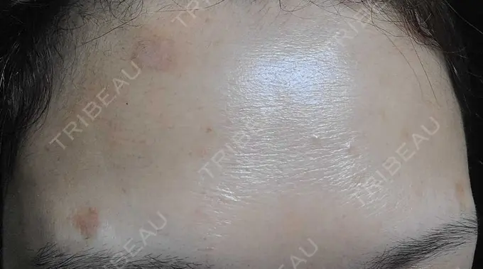 ボトックス（額） ルヴィクリニック イオンドーム前院 AFTER メイン用