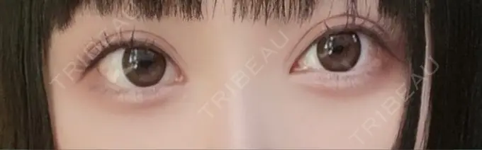 二重埋没 / 目頭切開 / クマ治療 / 目尻切開 / タレ目形成・グラマラスライン（切開） EMMA CLINIC（エマクリニック） DAY 94 メイン用