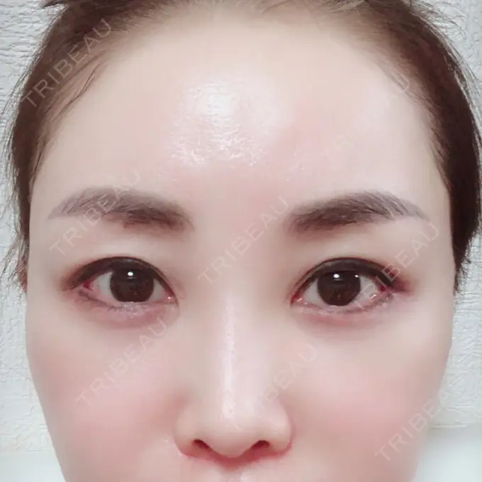 目頭切開 / 目尻切開 / 下まぶたの脂肪取り / タレ目形成・グラマラスライン（切開） / その他（目元） BIANCA銀座 DAY 116 メイン用