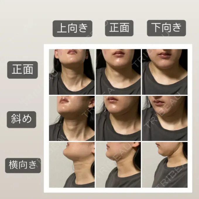 脂肪吸引（顔） 湘南美容クリニック 秋葉原院 DAY 14 メイン用